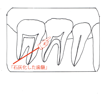 虫歯の歯髄