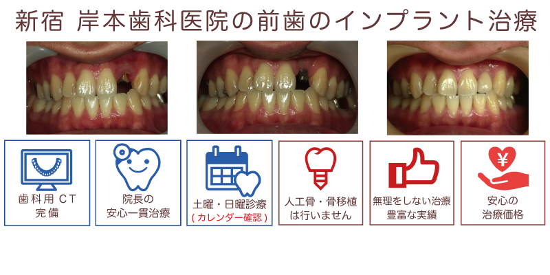 症例2-2上顎前歯部の骨造成無しでのインプラント治療 | 東京都新宿区の 